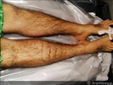 پایان عمر یک زندانی دیگر در زندان های جمهوری آذربایجان / شکنجه یا خود کشی ؟